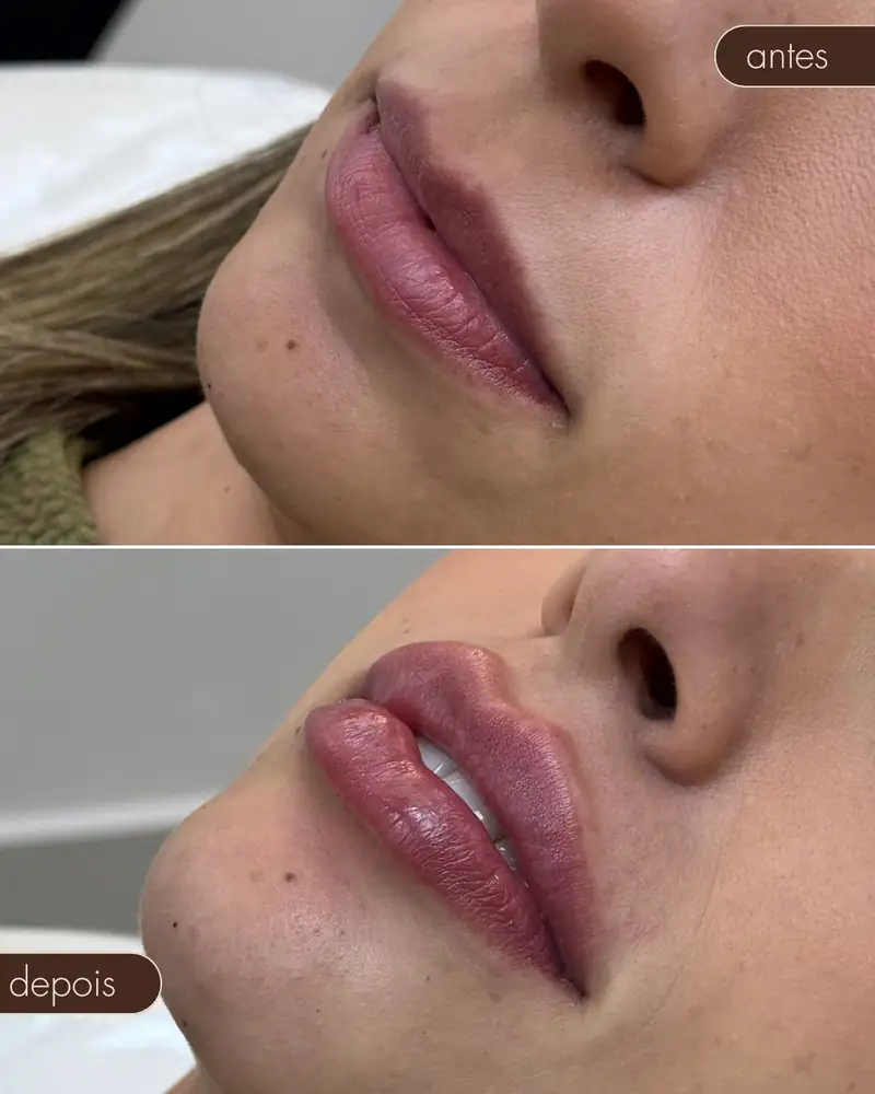 Antes e depois — Preenchimento de boca